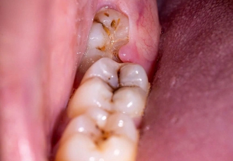 Sau Khi Nhổ Răng Khôn Bao Lâu Thì Lành